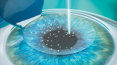 LASIK laser eye surgery step 3
