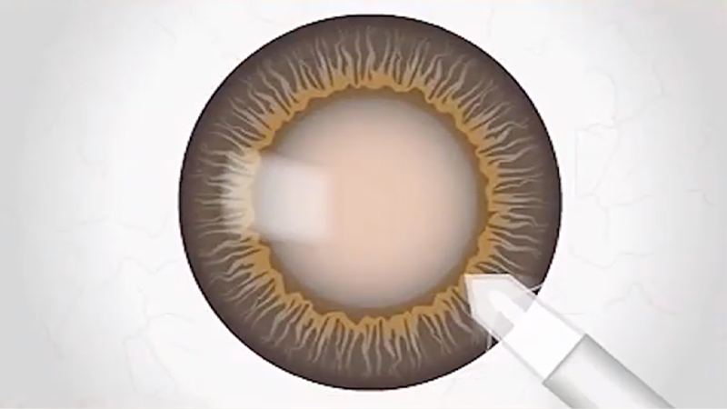 cataract surgery - corneal incision